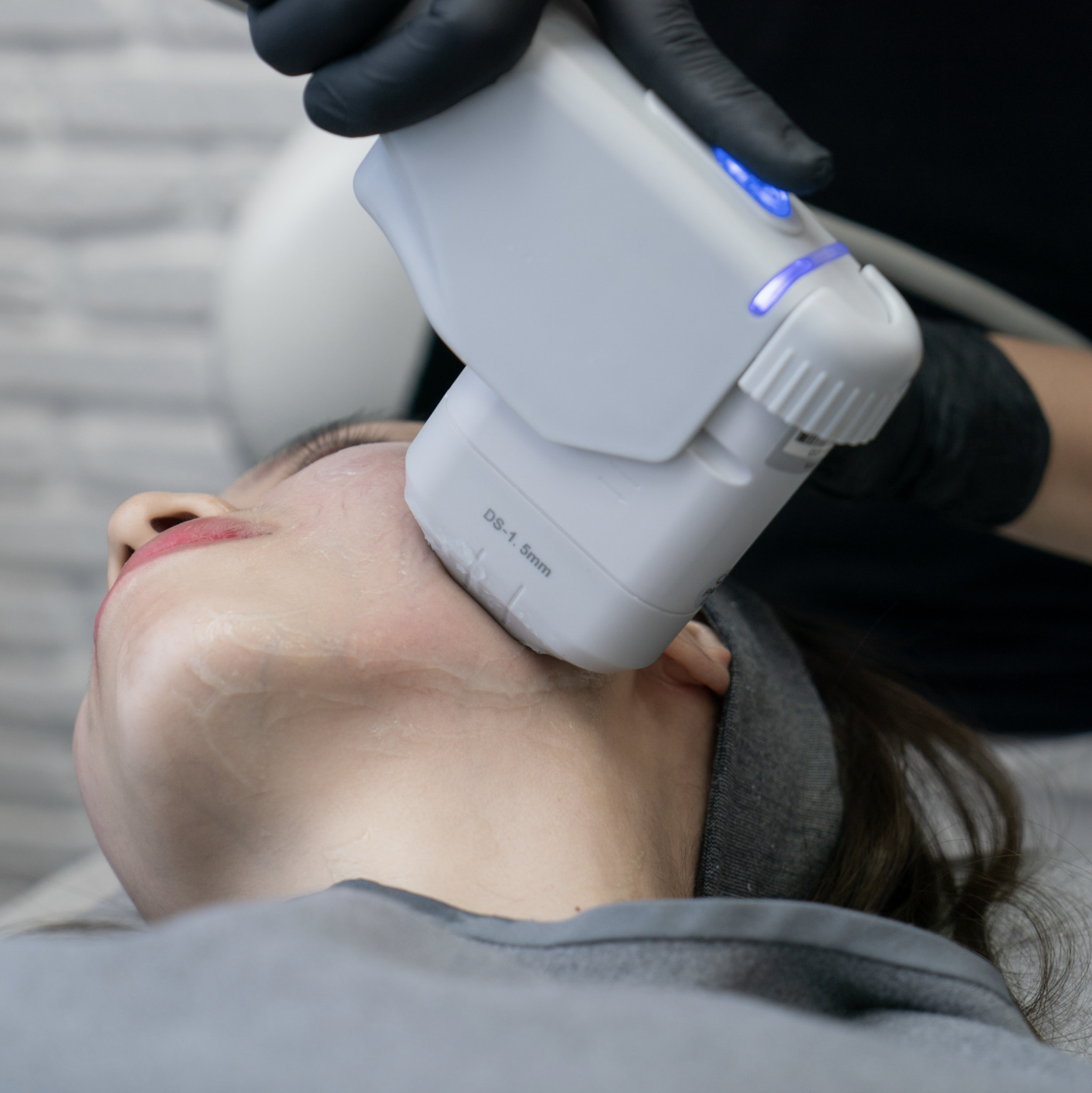 HIFU FACE LIFT TREATMENT BOURNEMOUTH