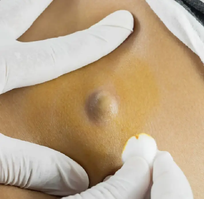 Sebaceous Cyst Removal in Bournemouth