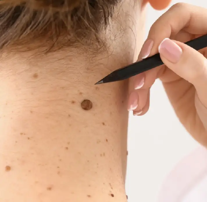 Skin Tag Removal in Bournemouth
